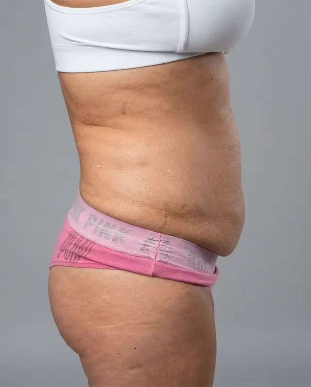 Antes: abdomen de perfil antes del tratamiento reductor