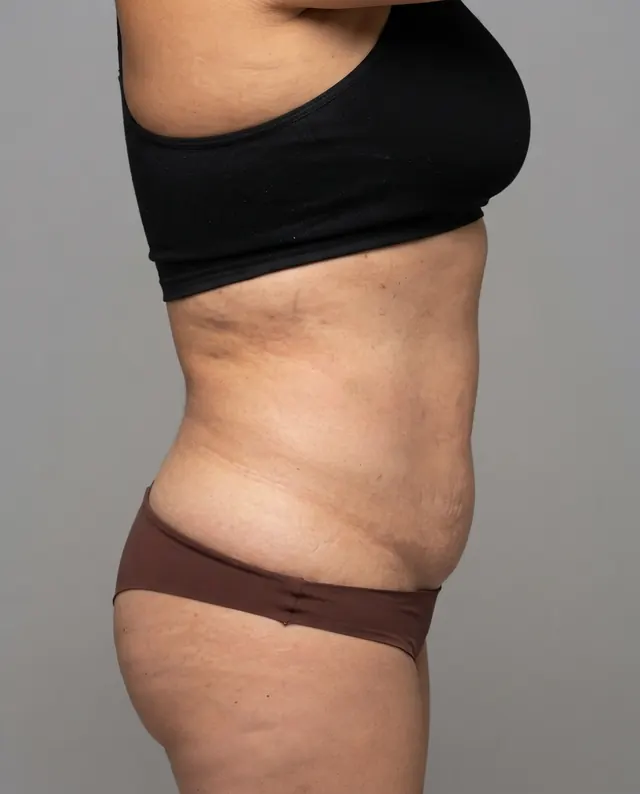 Después: abdomen más plano tras el tratamiento reductor